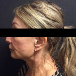 Ultherapy Case 2 After