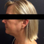 Ultherapy Case 3 After