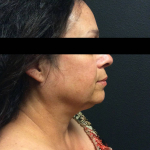 Ultherapy Case 4 Before