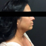 Ultherapy Case 4 After