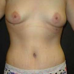 Tummy Tuck Case 4 After
