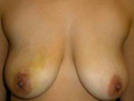 Breast Lift Case 1 Before