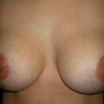 Breast Lift Case 1 After