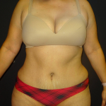 Tummy Tuck Case 7 After