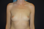 Breast Augmentation Case 13 Before