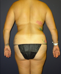 Total Back Liposuction Before