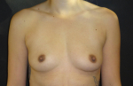 Breast Augmentation Case 15 Before