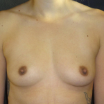 Breast Augmentation Case 15 Before