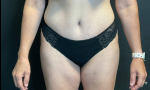 Tummy Tuck Case 10 After