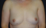 Breast Augmentation Case 16 Before