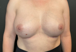 Breast Augmentation Case 16 After
