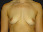 Breast Augmentation Case 19 Before