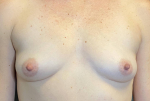 Breast Augmentation Case 24 Before