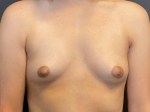 Breast Augmentation Case 25 Before