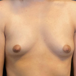 Breast Augmentation Case 25 Before