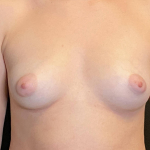 Breast Augmentation Case 27 Before