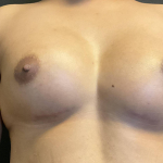 Breast Augmentation Case 28 After