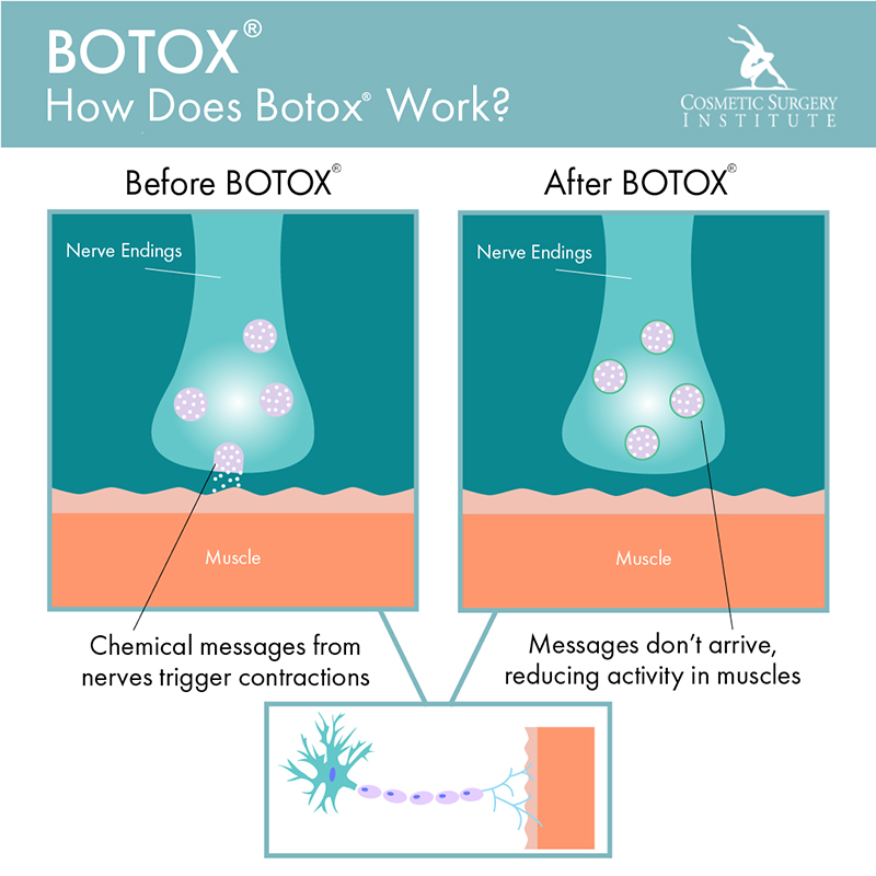 Discover the mechanics behind BOTOX® from the Los Angeles area’s Cosmetic Surgery Institute.