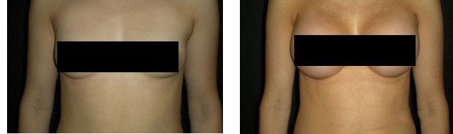 Breast-augmentation-before-and-after-new