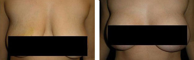 Breast-lift-before-and-after