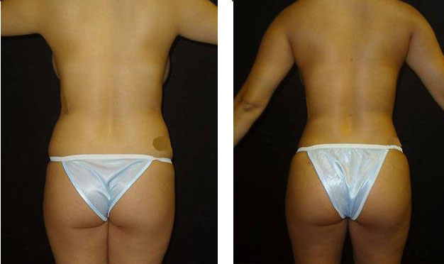 Butt Lift Before And After