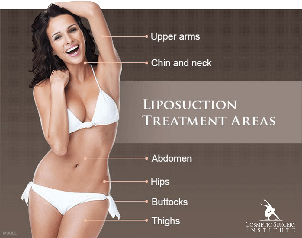 Discover the most common areas for liposuction at the Los Angeles area’s Cosmetic Surgery Institute.