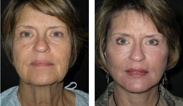 Facelift Necklift Before And After