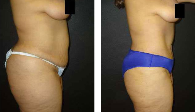 Tummy Tuck Before And After