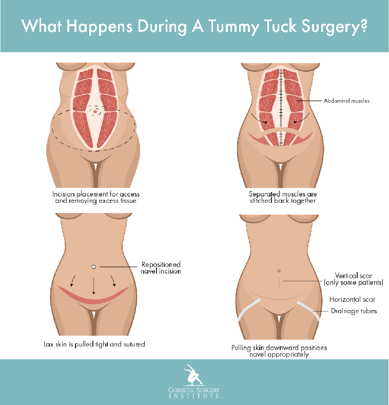 See the four steps of a tummy tuck at the Los Angeles/Palm Desert-area’s Cosmetic Surgery Institute.