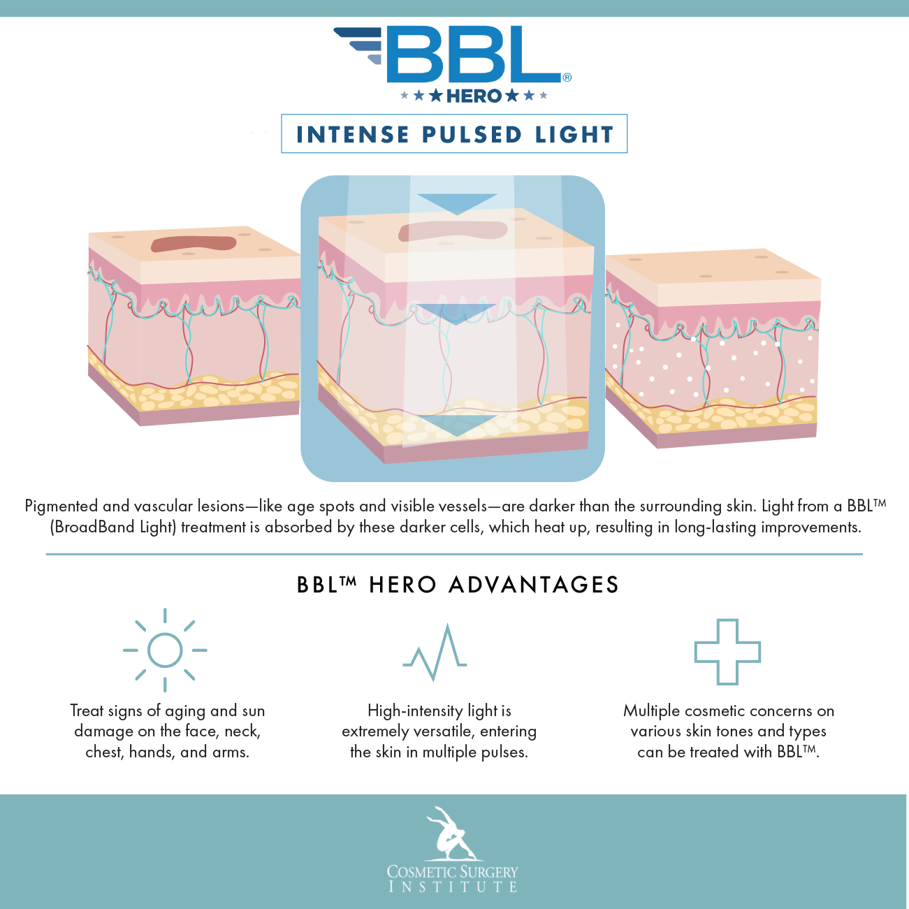 See how light powers BBL™ (BroadBand Light), a type of IPL at Palm Desert’s Cosmetic Surgery Institute.