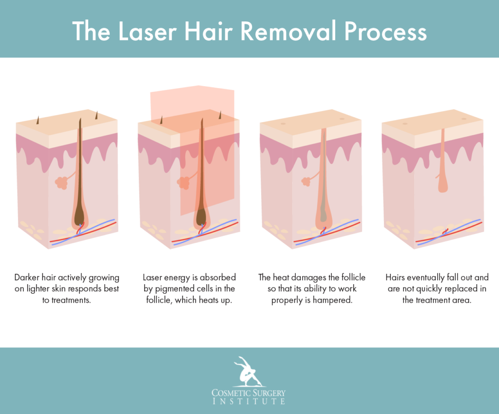 Laser Hair Removal 